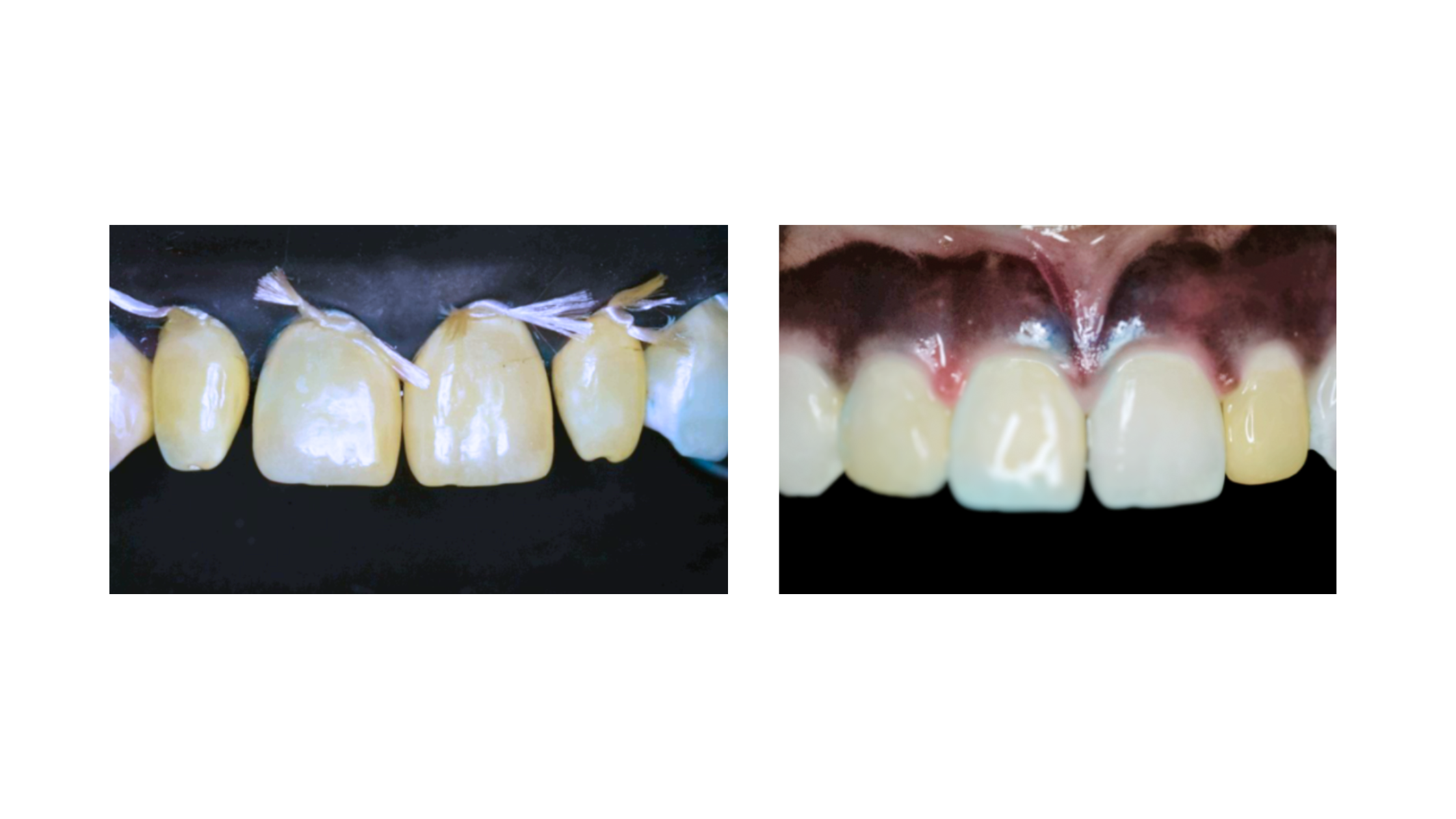 Composite bonding to fix the shape of a triangular incisor