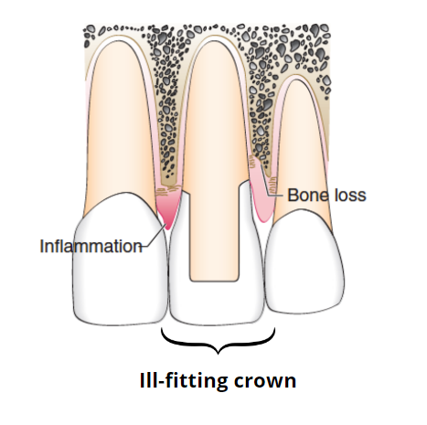 An ill-fitting crown causing gum inflammation and recession