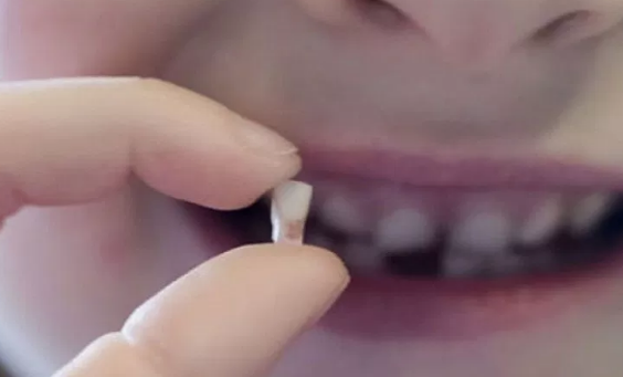 Baby tooth extraction