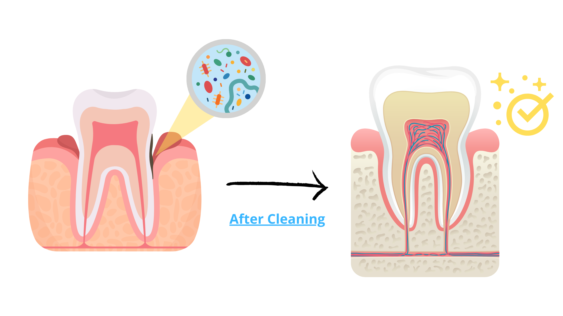 Deep dental cleaning before and after