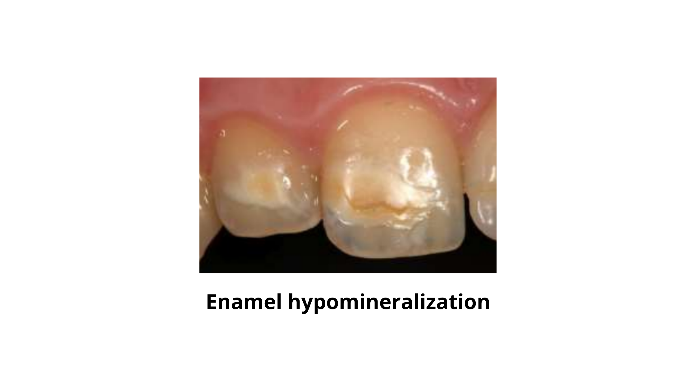 enamel hypomineralization on the incisors