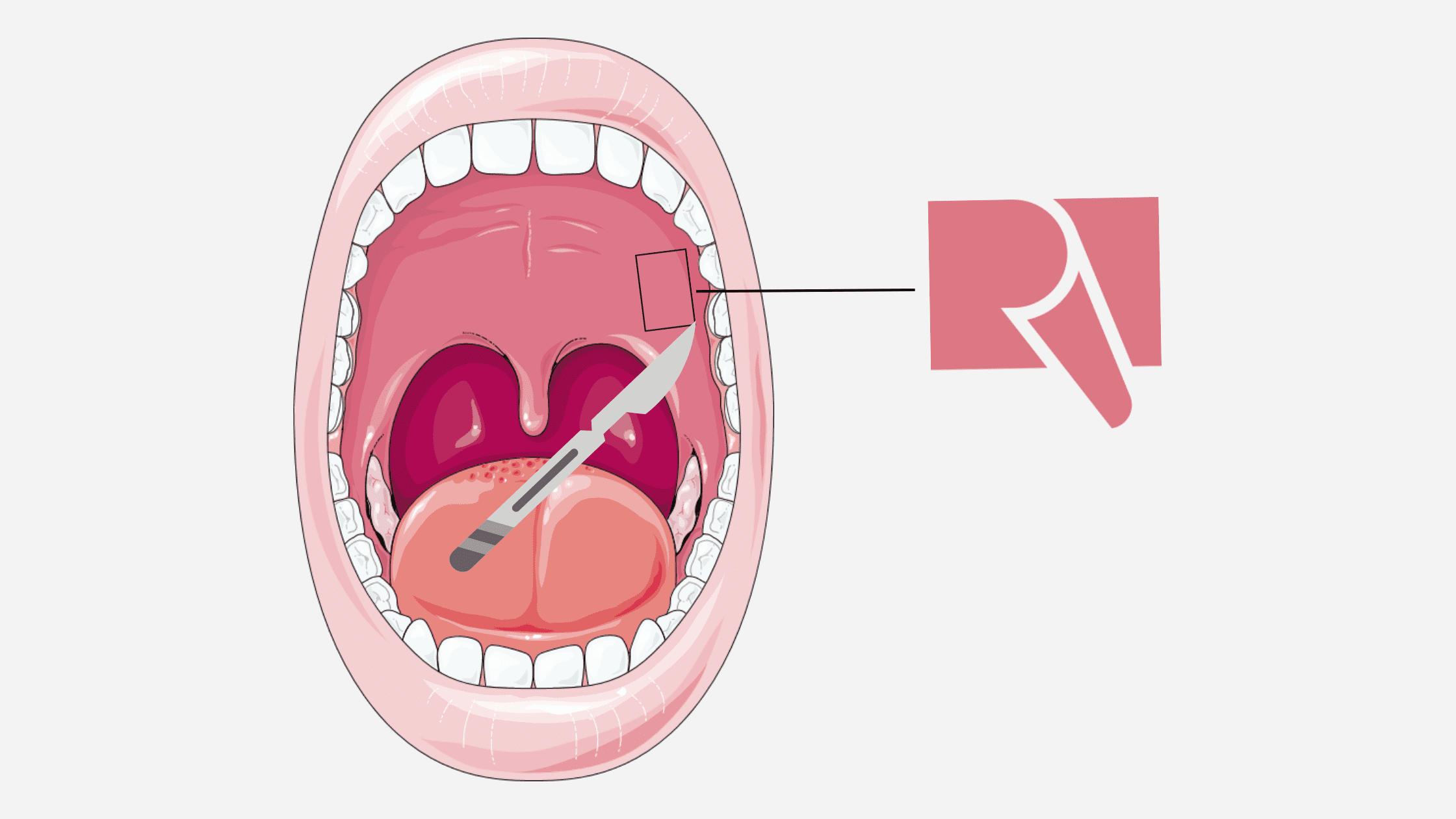 The donor site (palate) of a gum graft