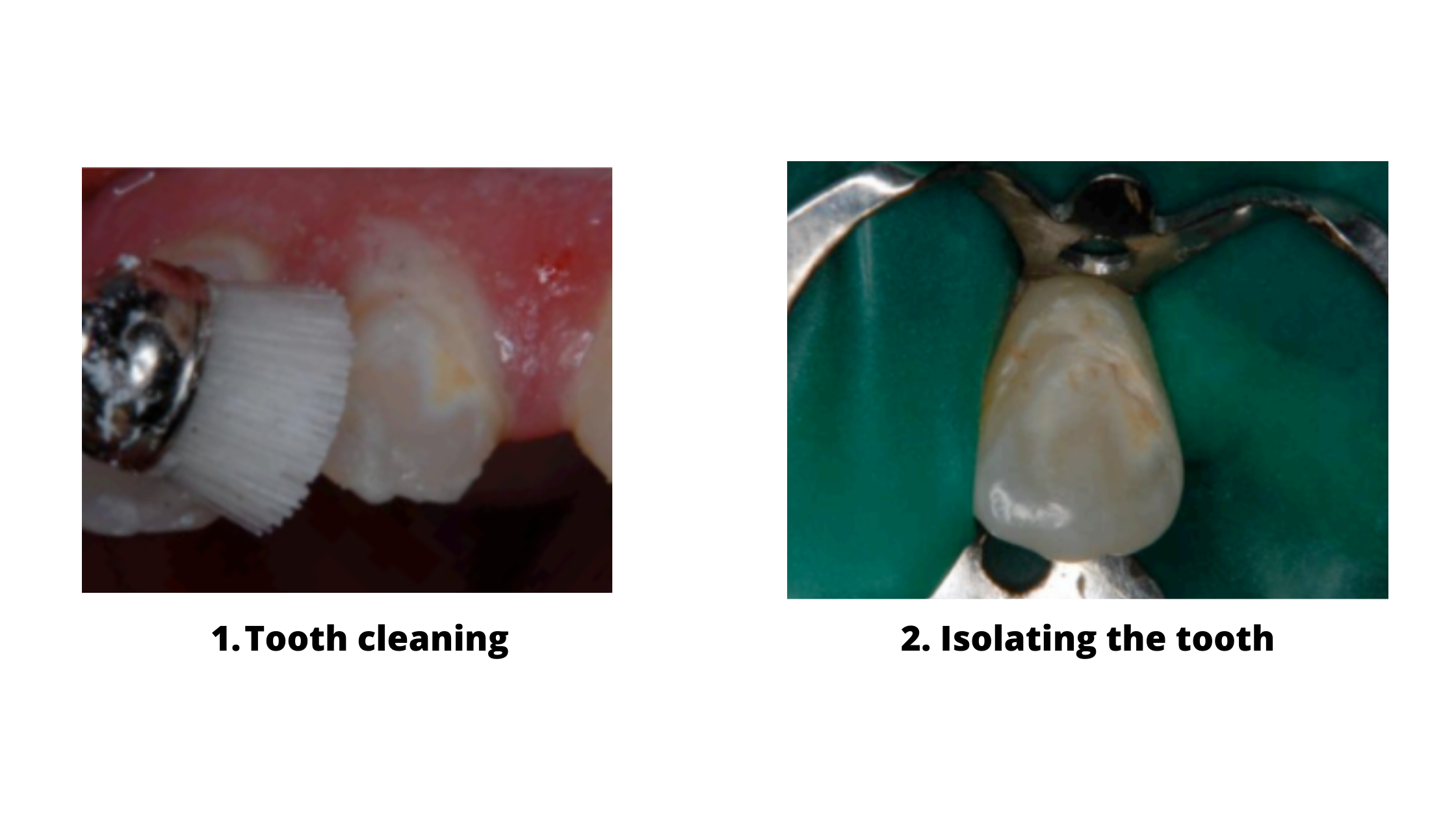 tooth preparation: cleaning and isolating the tooth