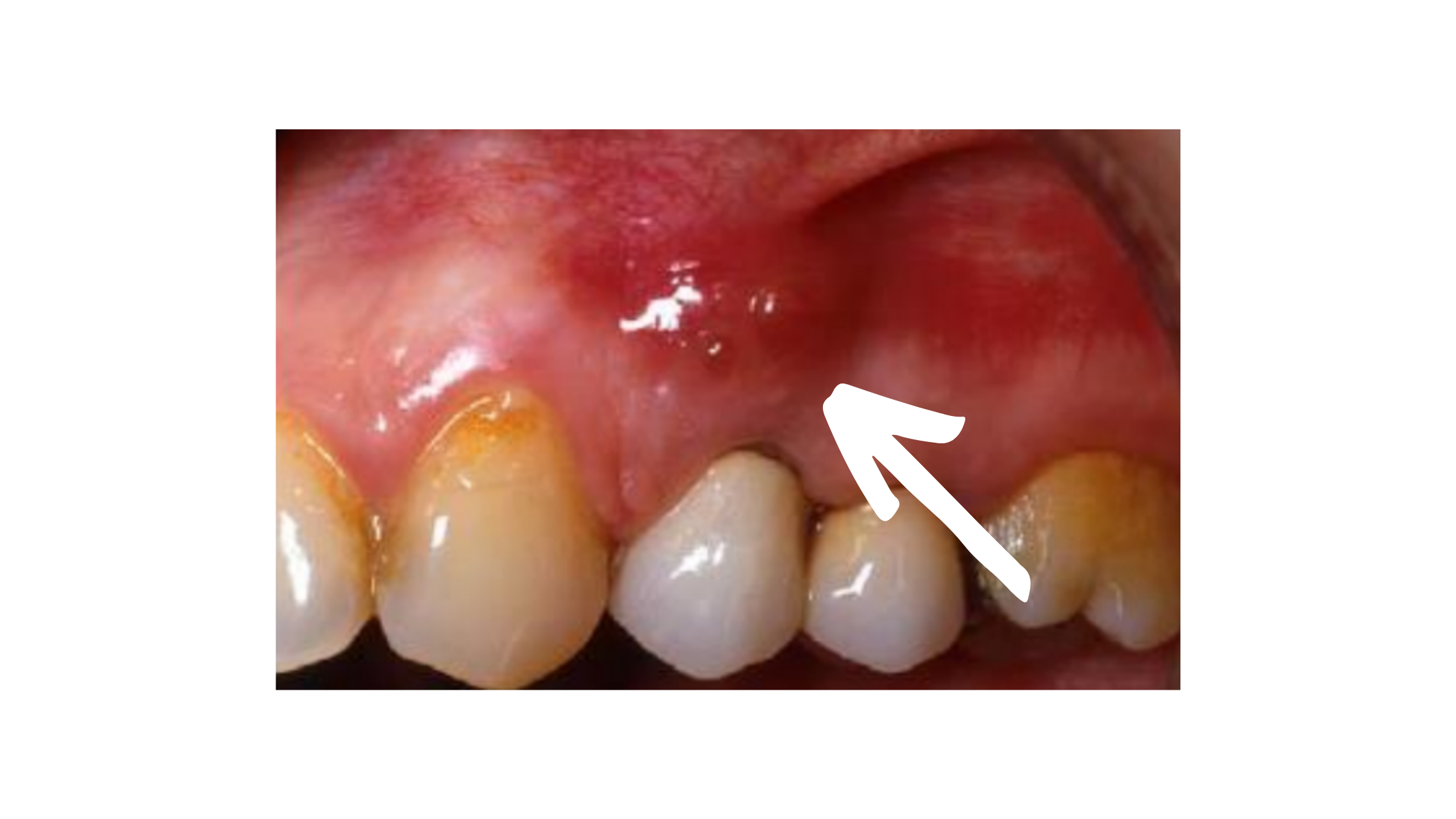 Clinical image of periapical abscess