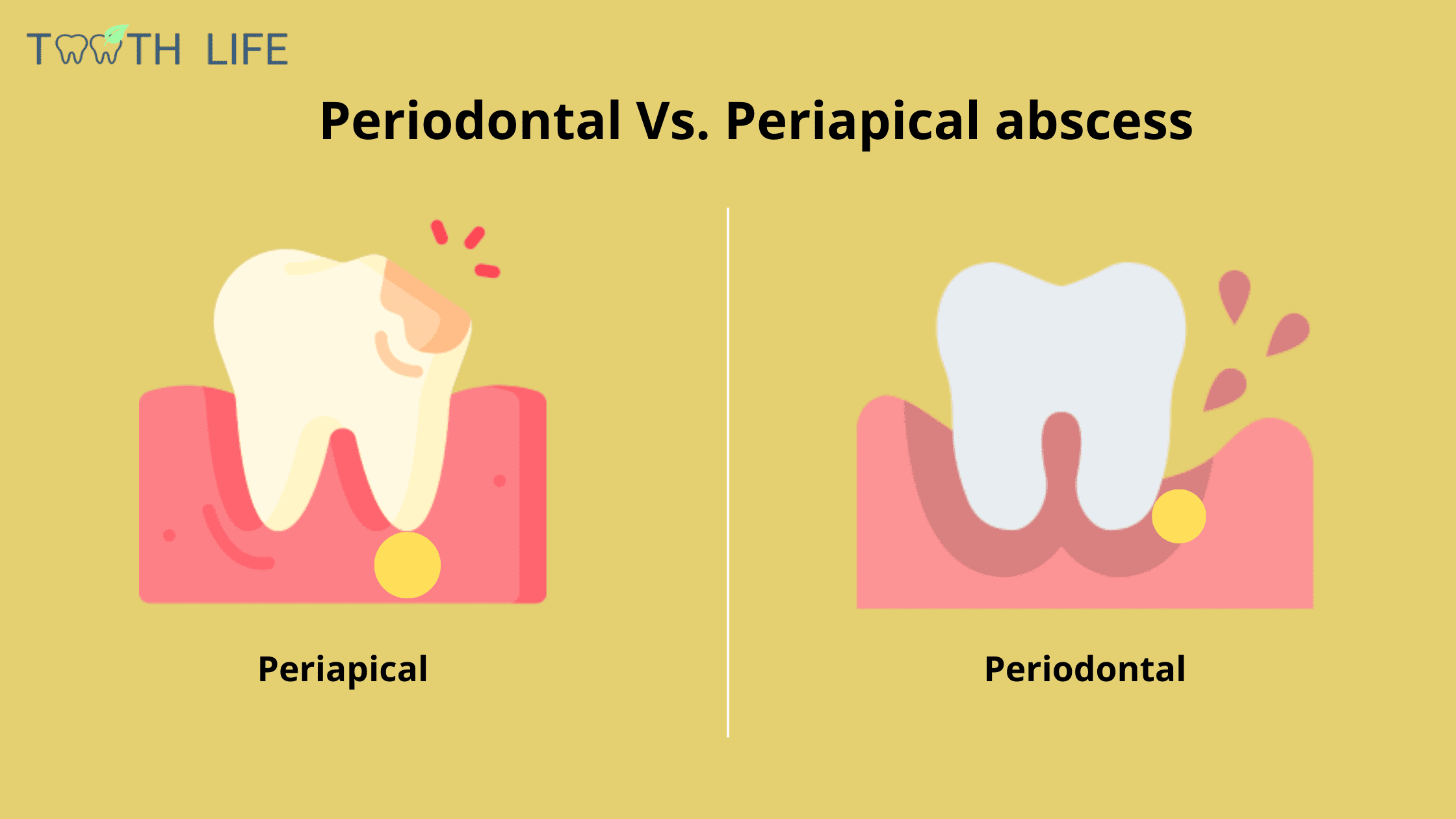 periapical vs. periodontal abscess