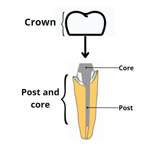 post and core crown