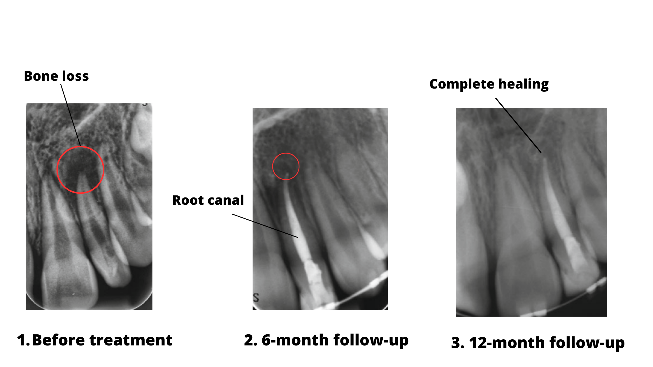 3 X-Rays showing the healing stages of a periapical abscess before treatment, 6-month follow-up and 12-month follow-up