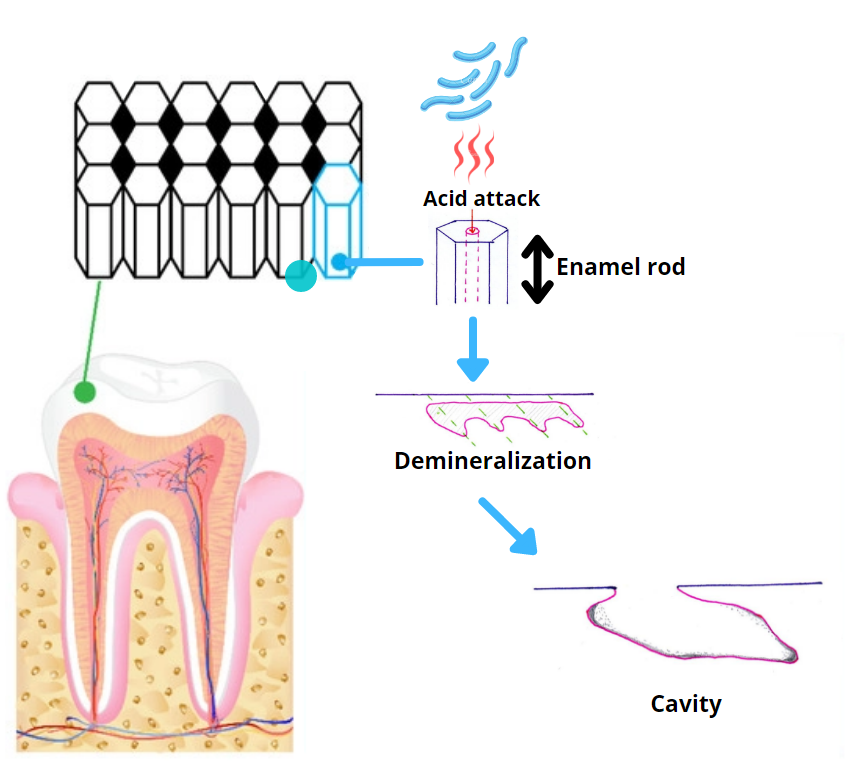 Tooth decay progress: From demineralization to cavity
