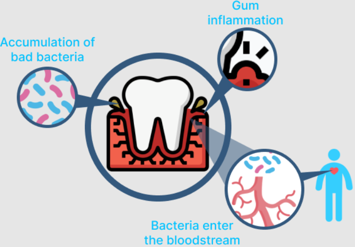dental infection spreading to the heart via the bloodstream