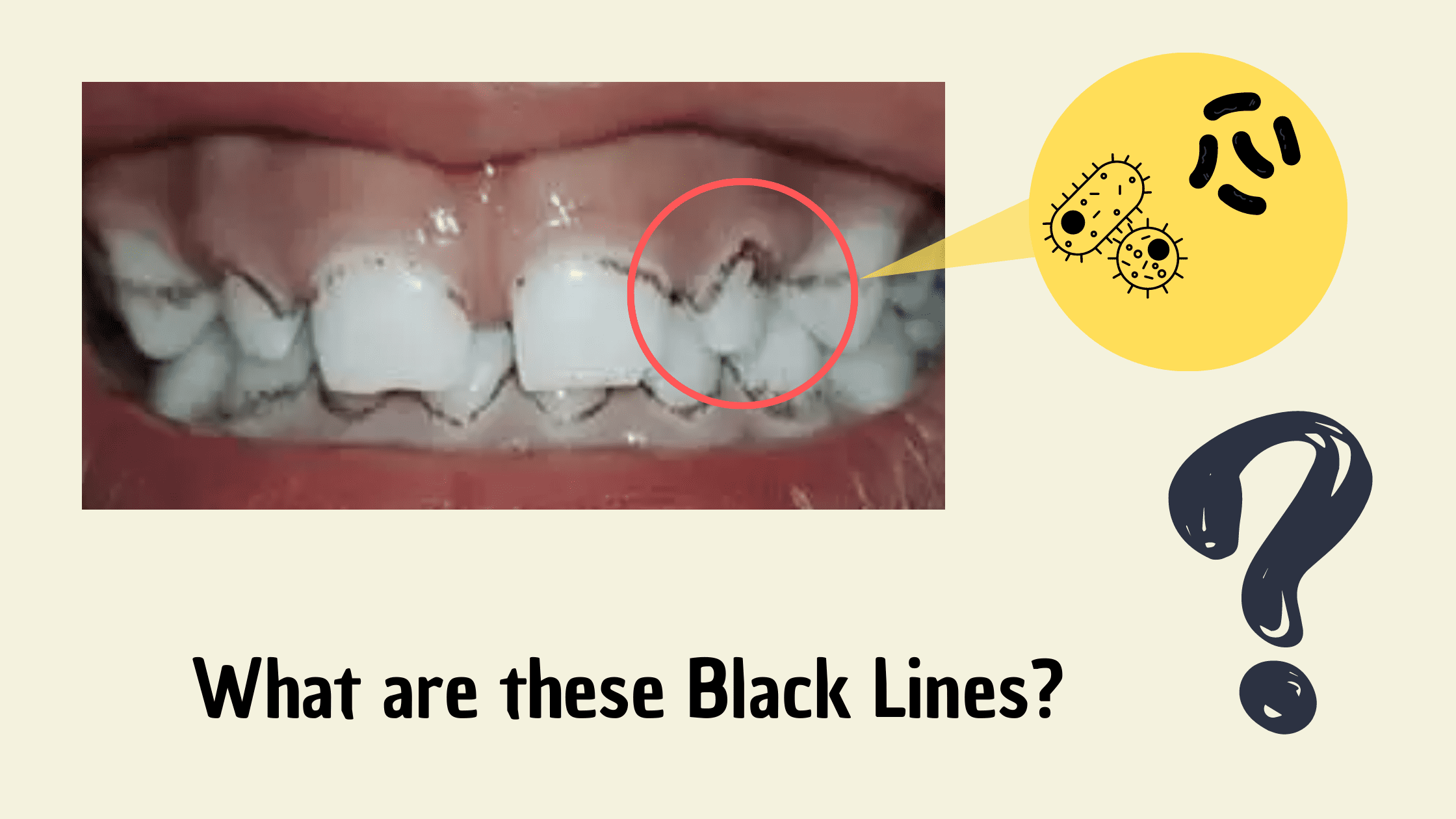 Clinical image of black lines on teeth and the involved bacteria