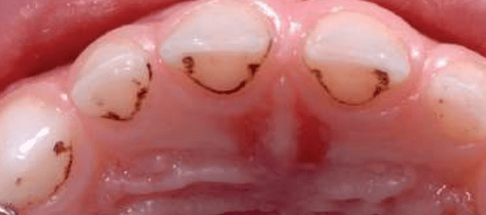 black lines on primary teeth