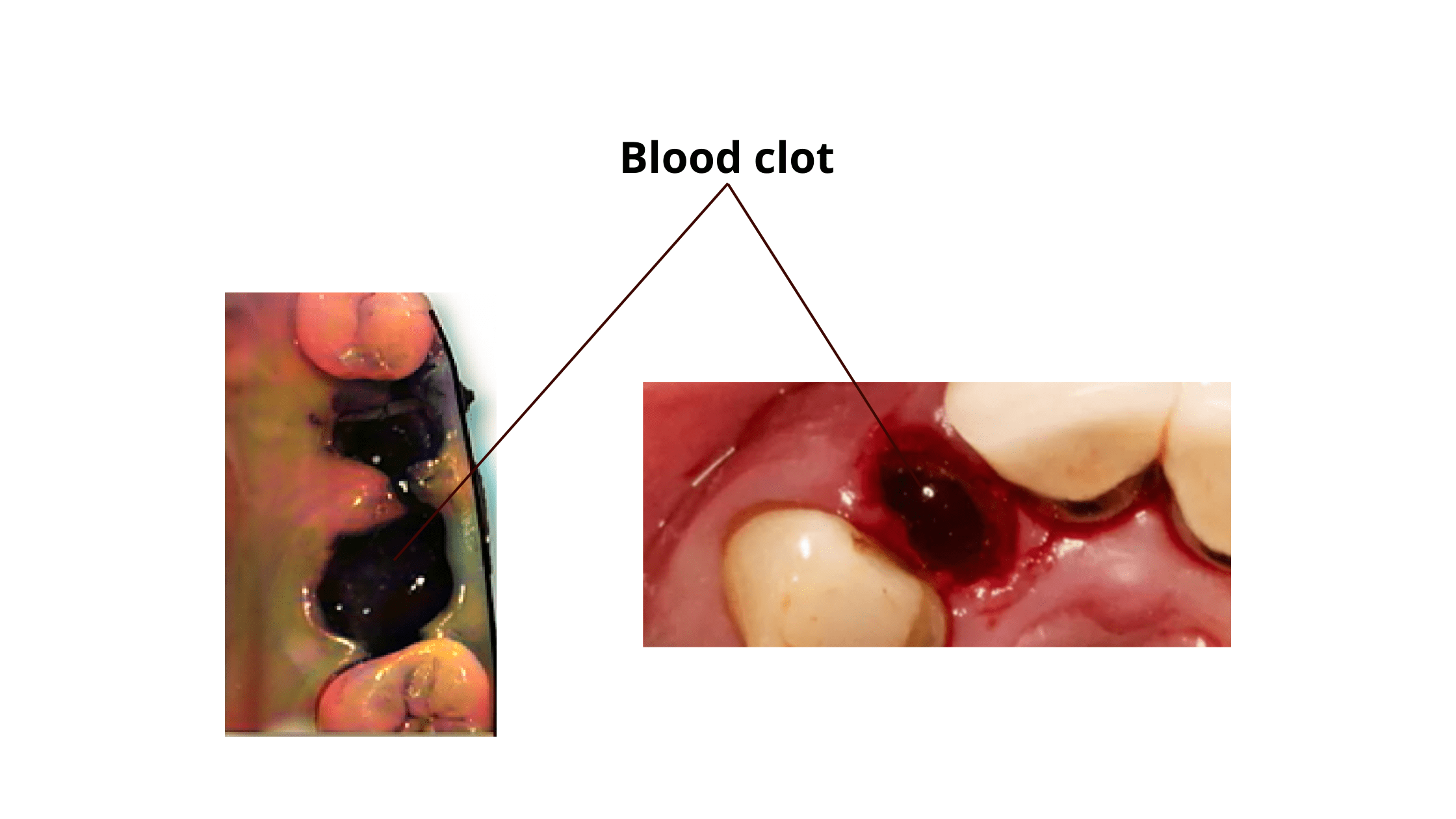 Blood clot after tooth extraction