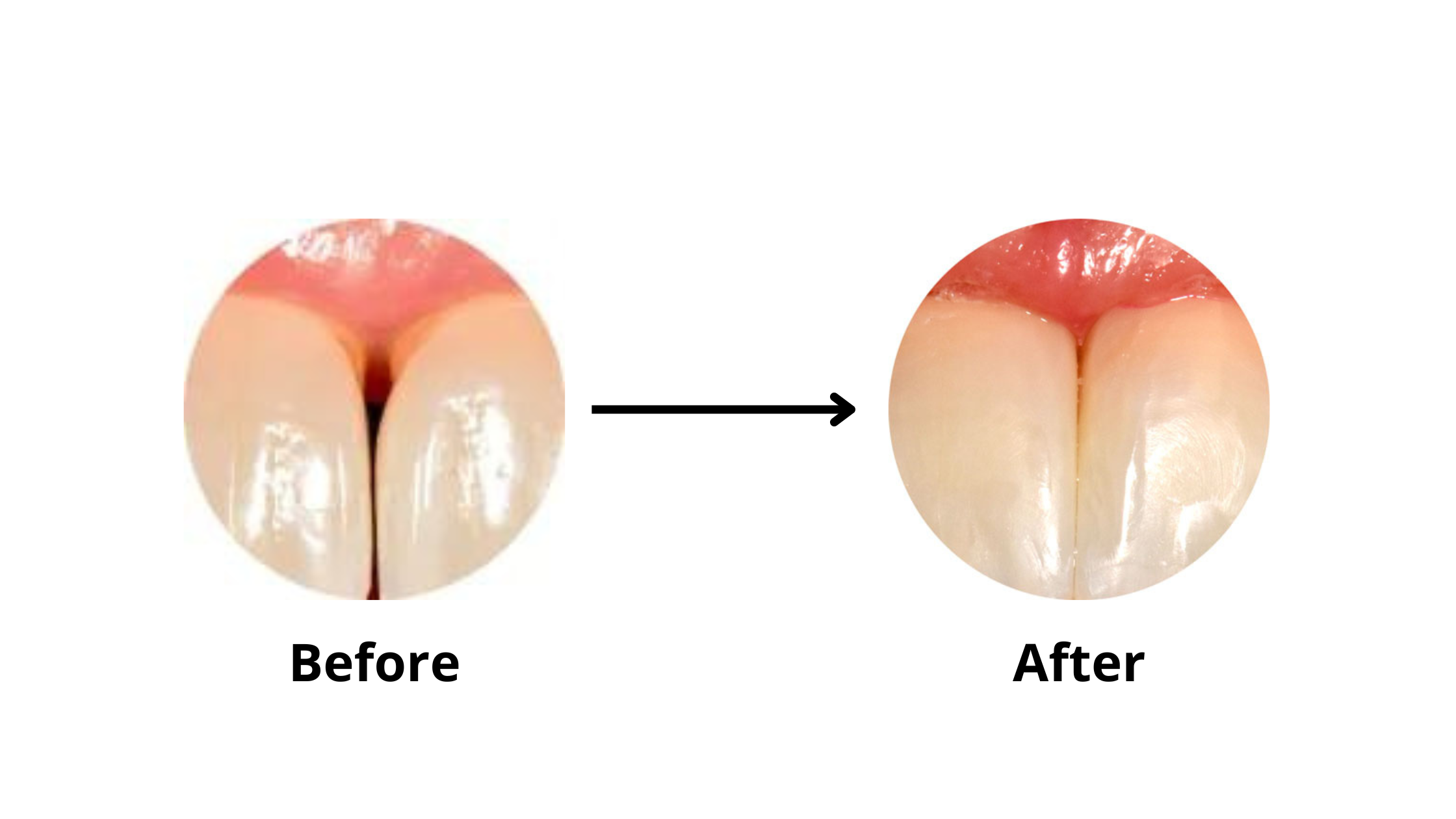 dental bonding to close black gap between front teeth