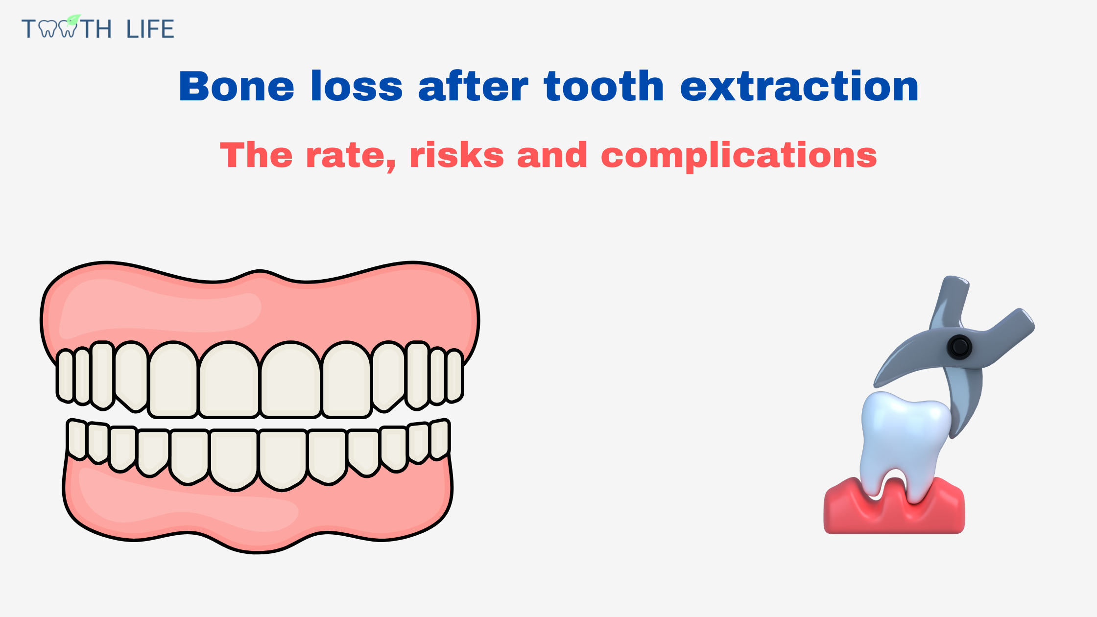 Bone loss after tooth extraction