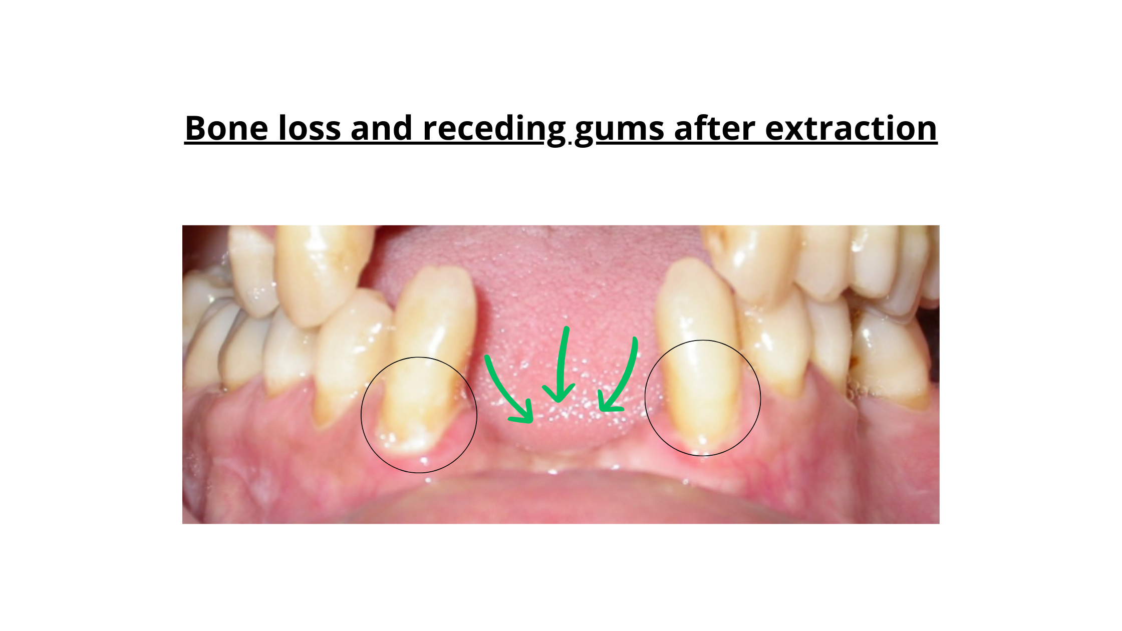 Receding gums due to bone loss following tooth extraction