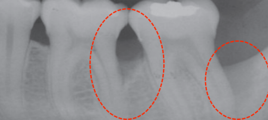Dental x-rays showing bone loss due to periodontal disease