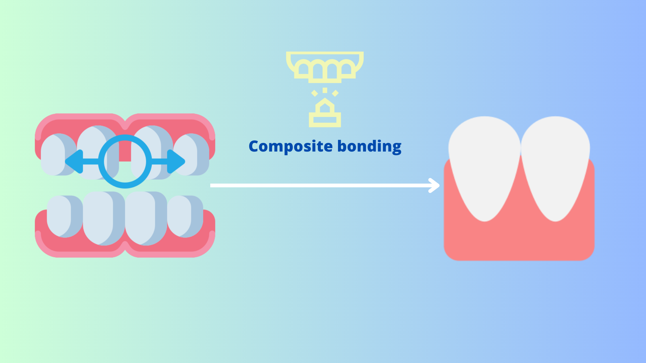 Dental bonding to fix diastemas