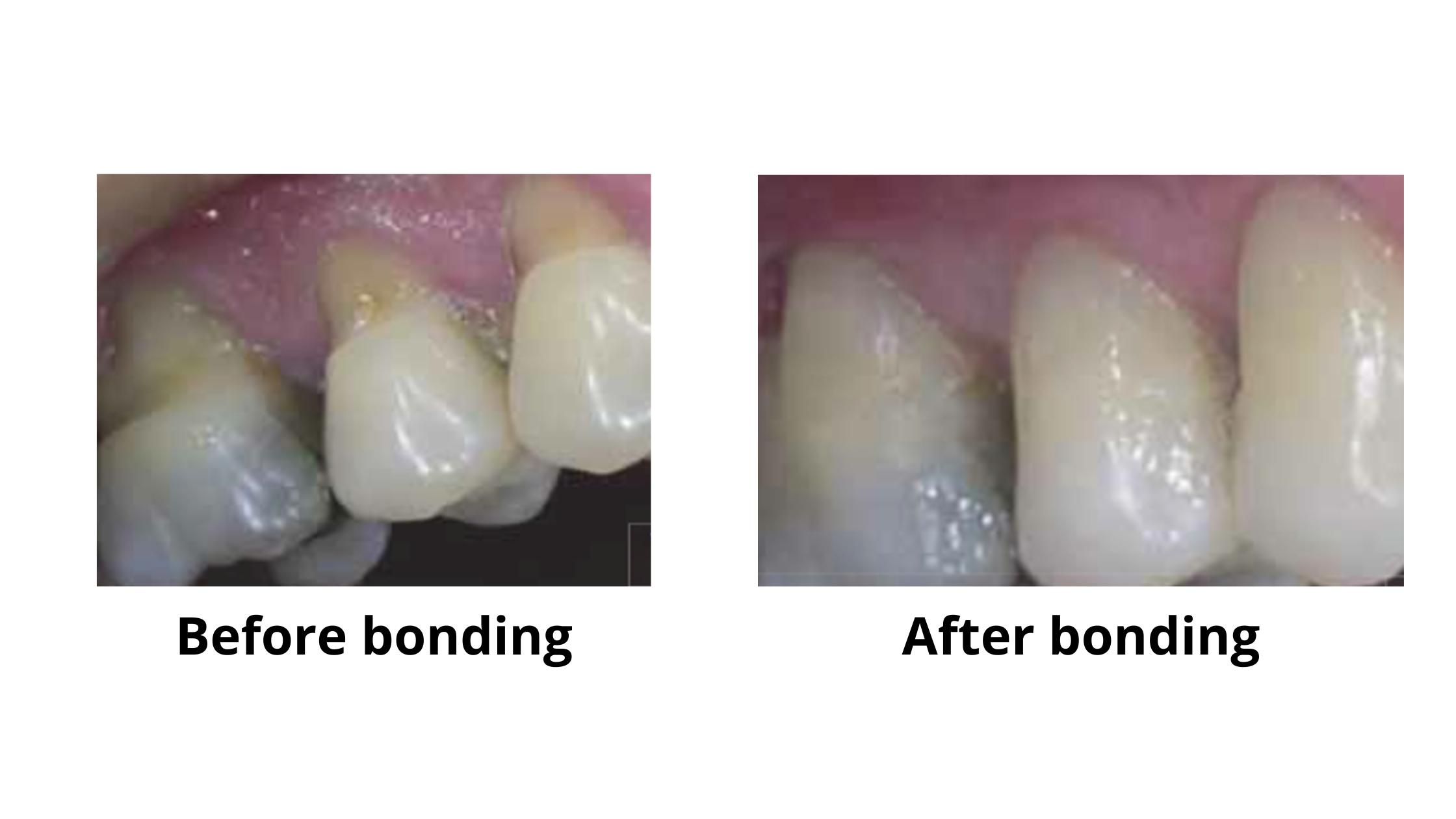 composite bonding before and after to restore worn teeth