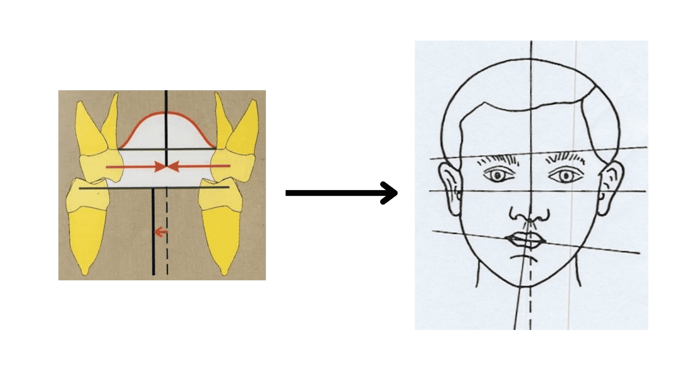 Crossbite and facial asymmetry