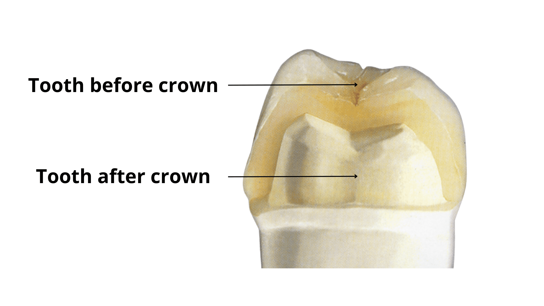 The shape of the tooth before and after a dental crown