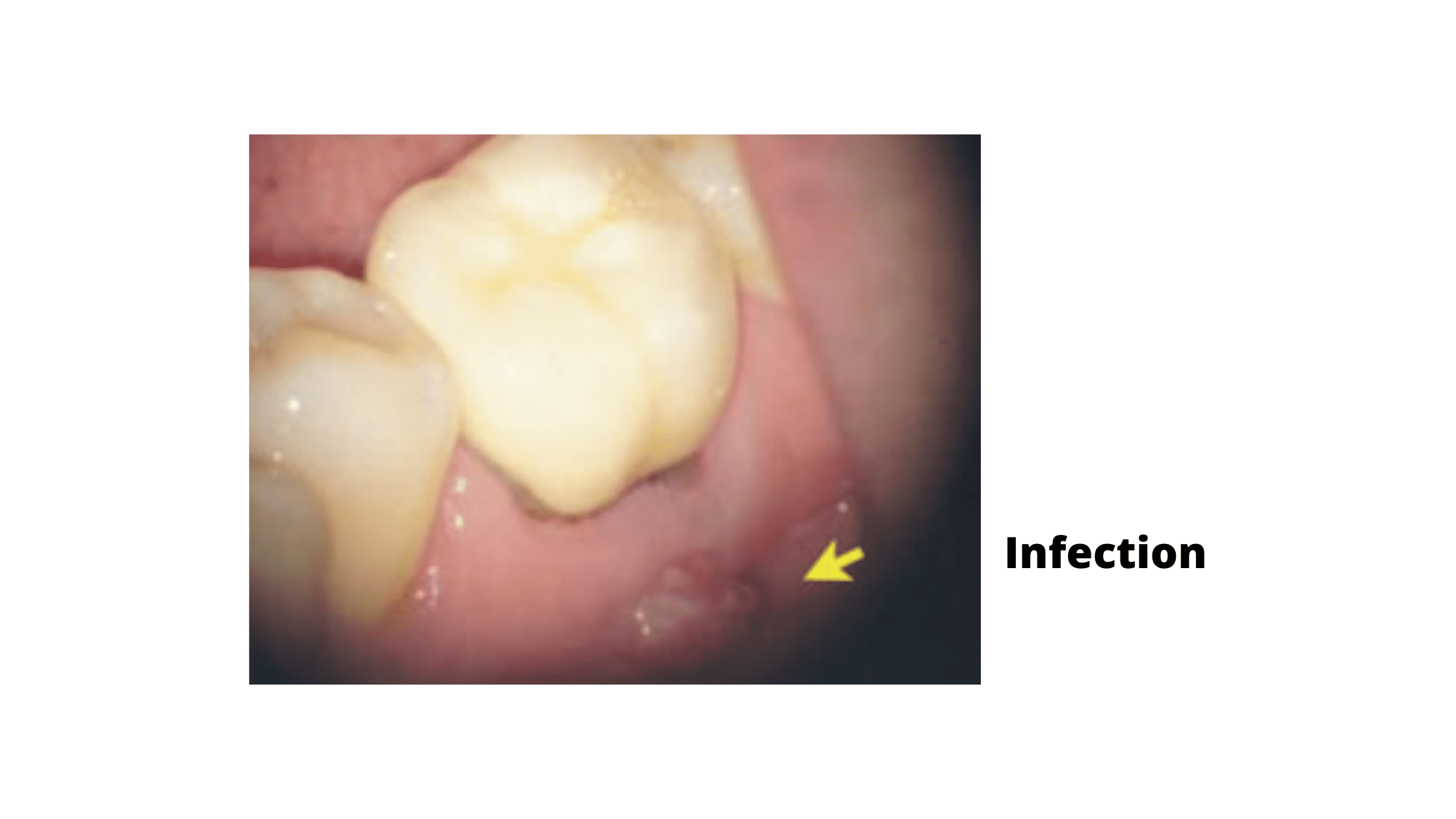 Infection of a crowned tooth