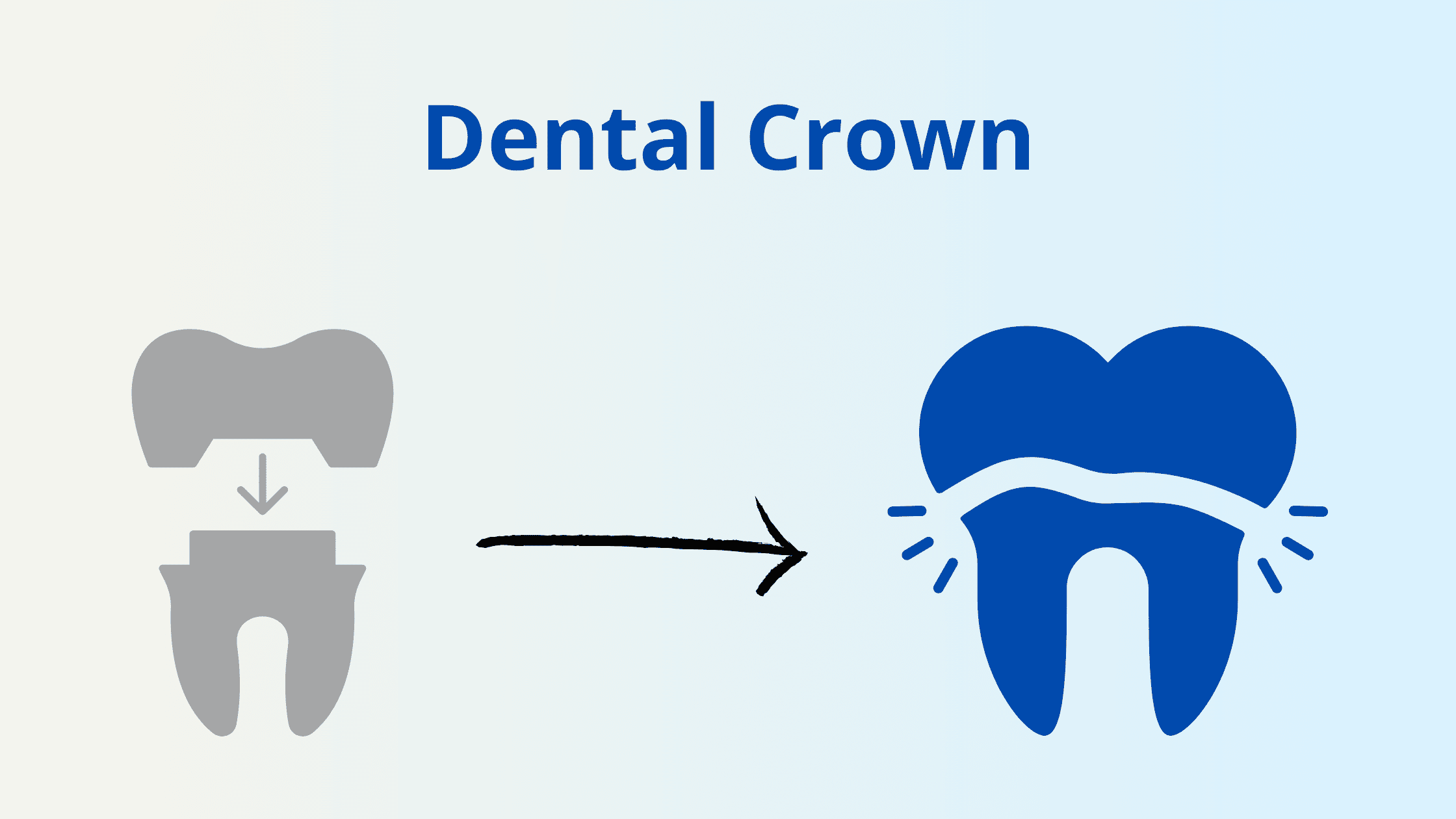 dental filling crown