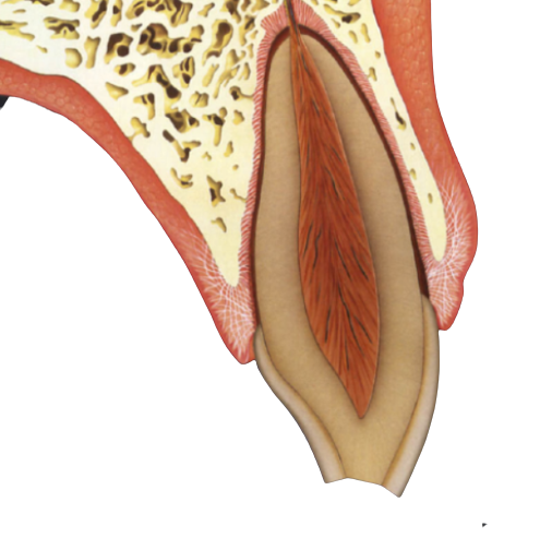 Enamel-Dentin Horizontal fracture