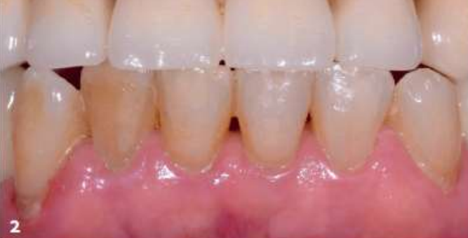 extrinsic tooth stains due to pigmented foods