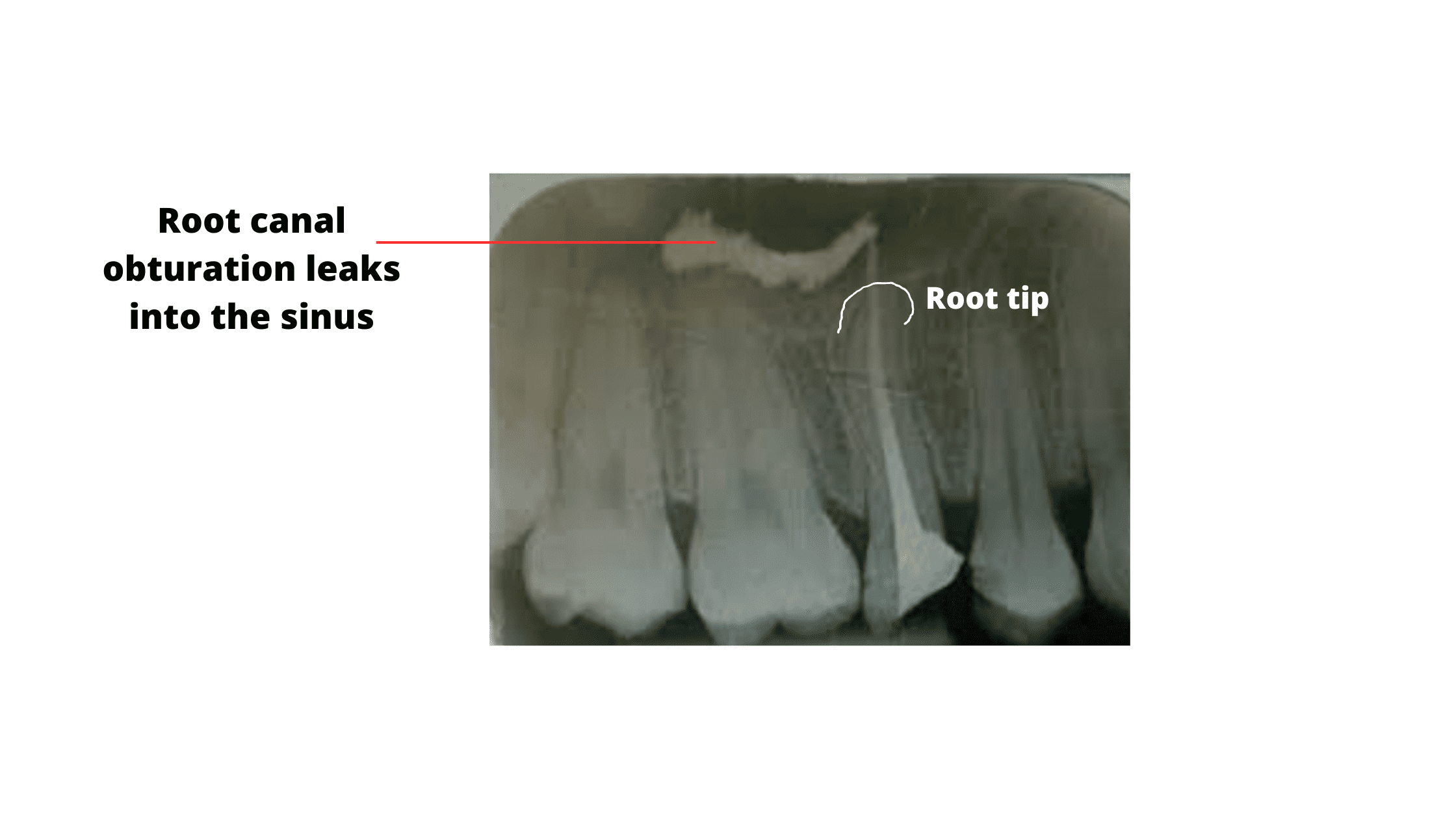 Leakage of the root canal filling into the sinus