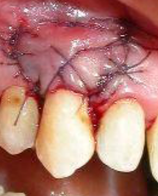 the recipient site after a free gingival graft