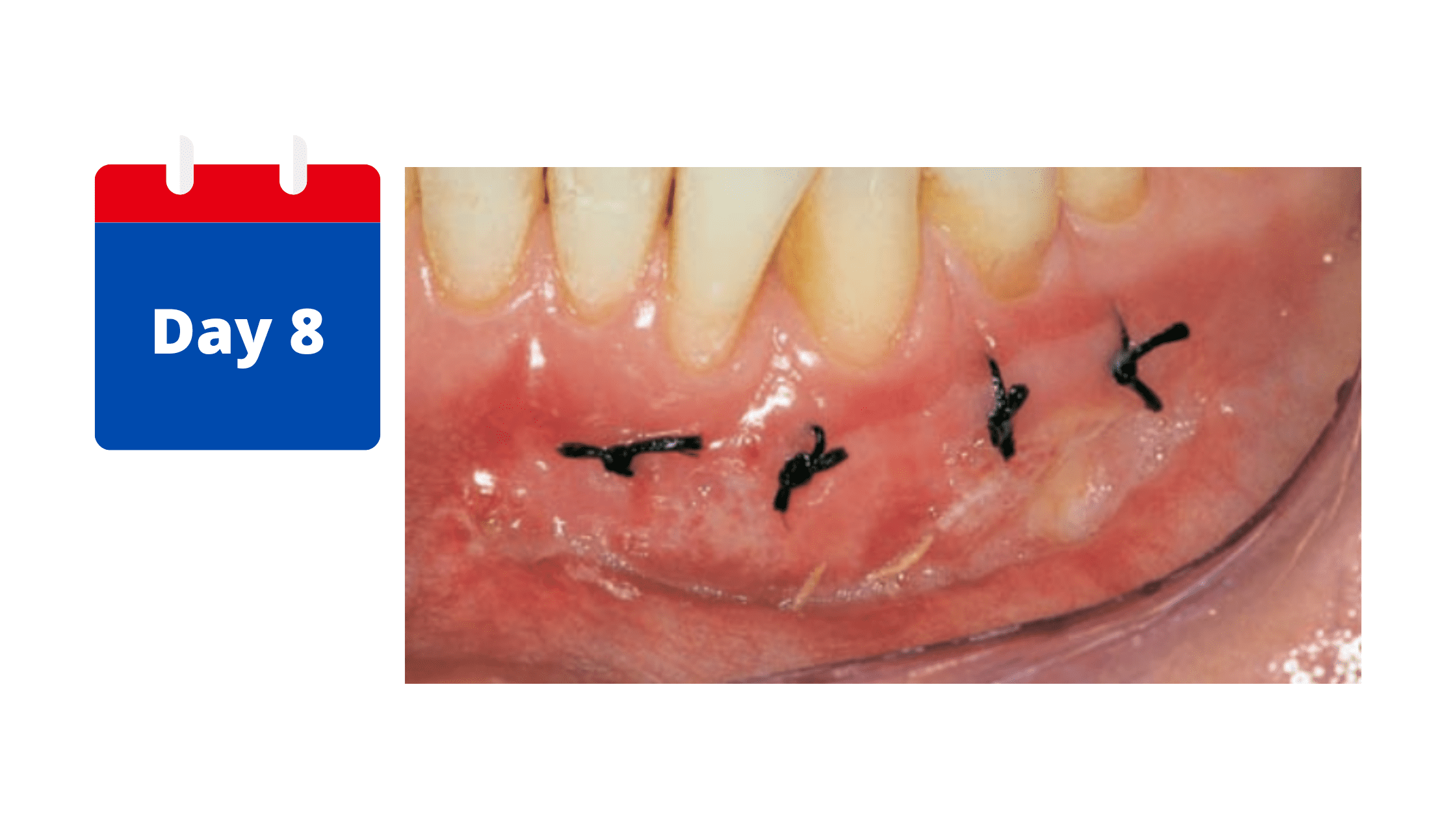 The third stage of gum graft healing: After 8 days 