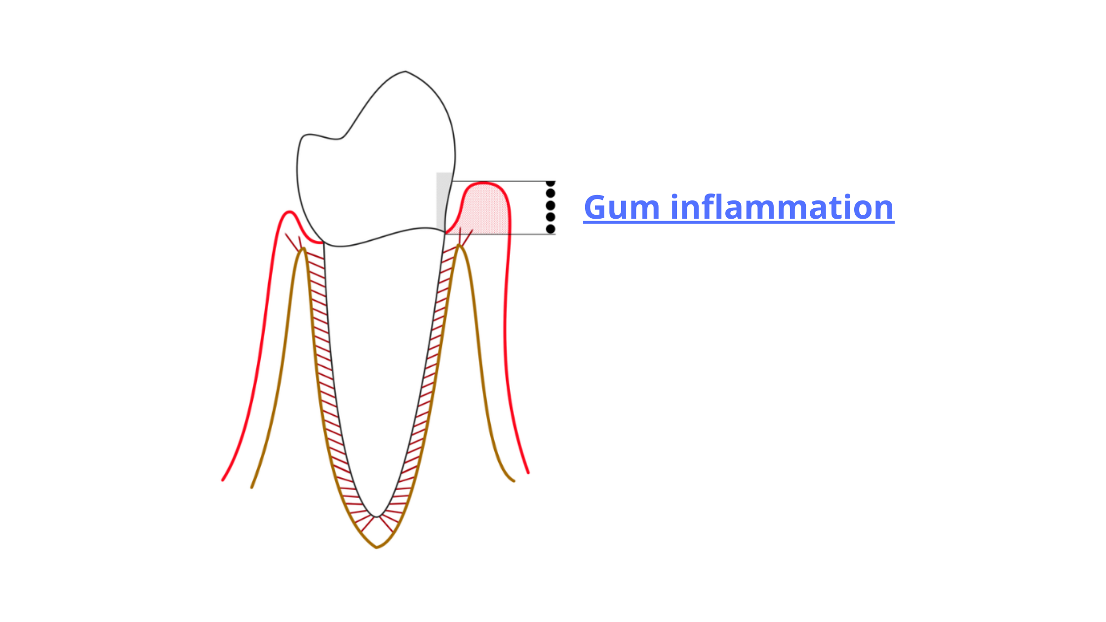 Initial stage of gum disease: gingivitis