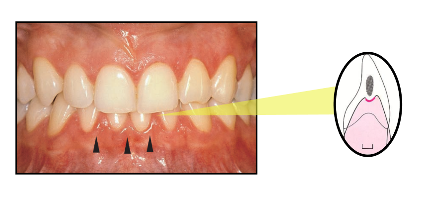 gum hurts between teeth-bone-loss.php