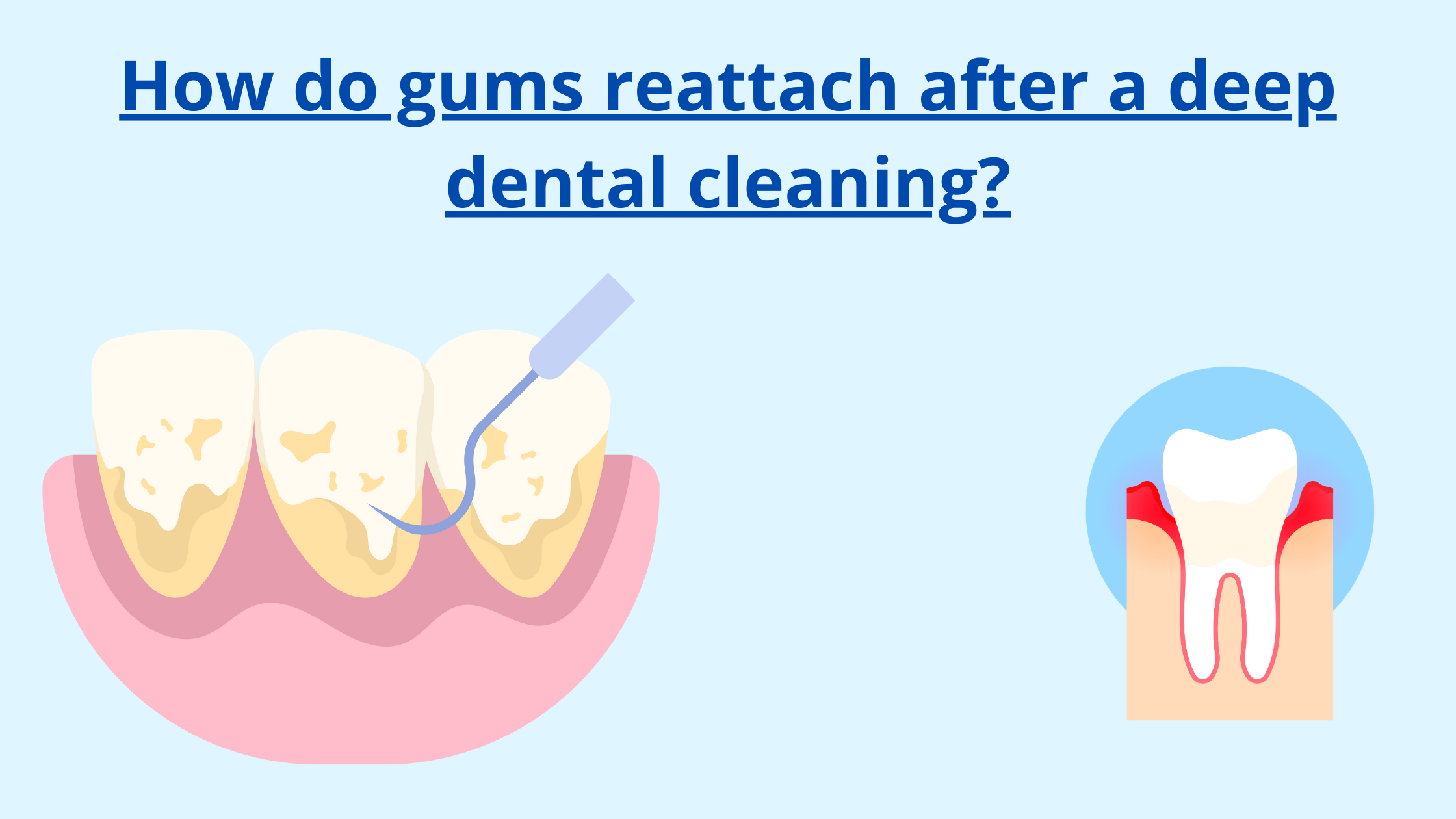 Gum reattachment after deep cleaning