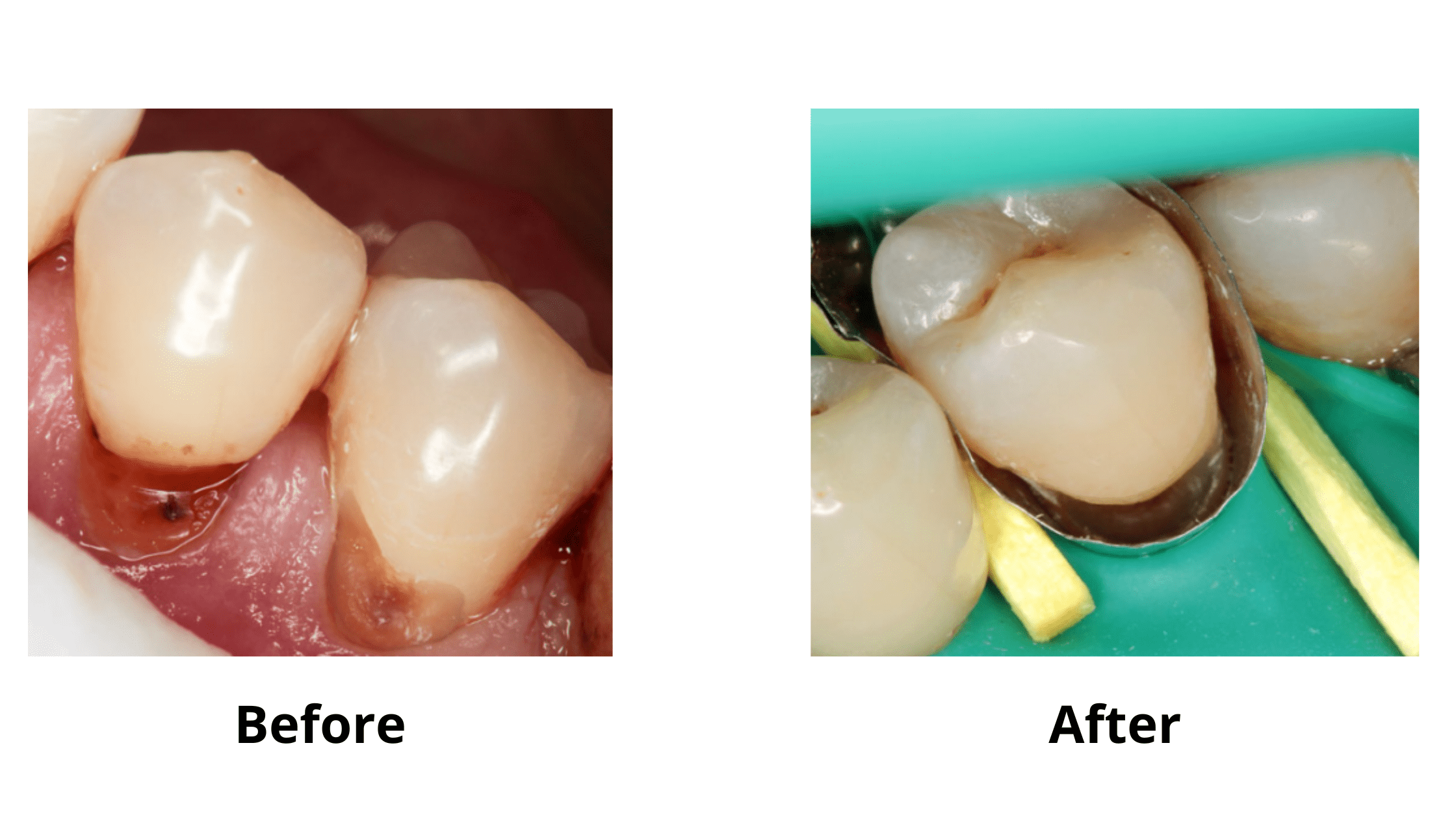 Tooth decay at gum line filling: before and after