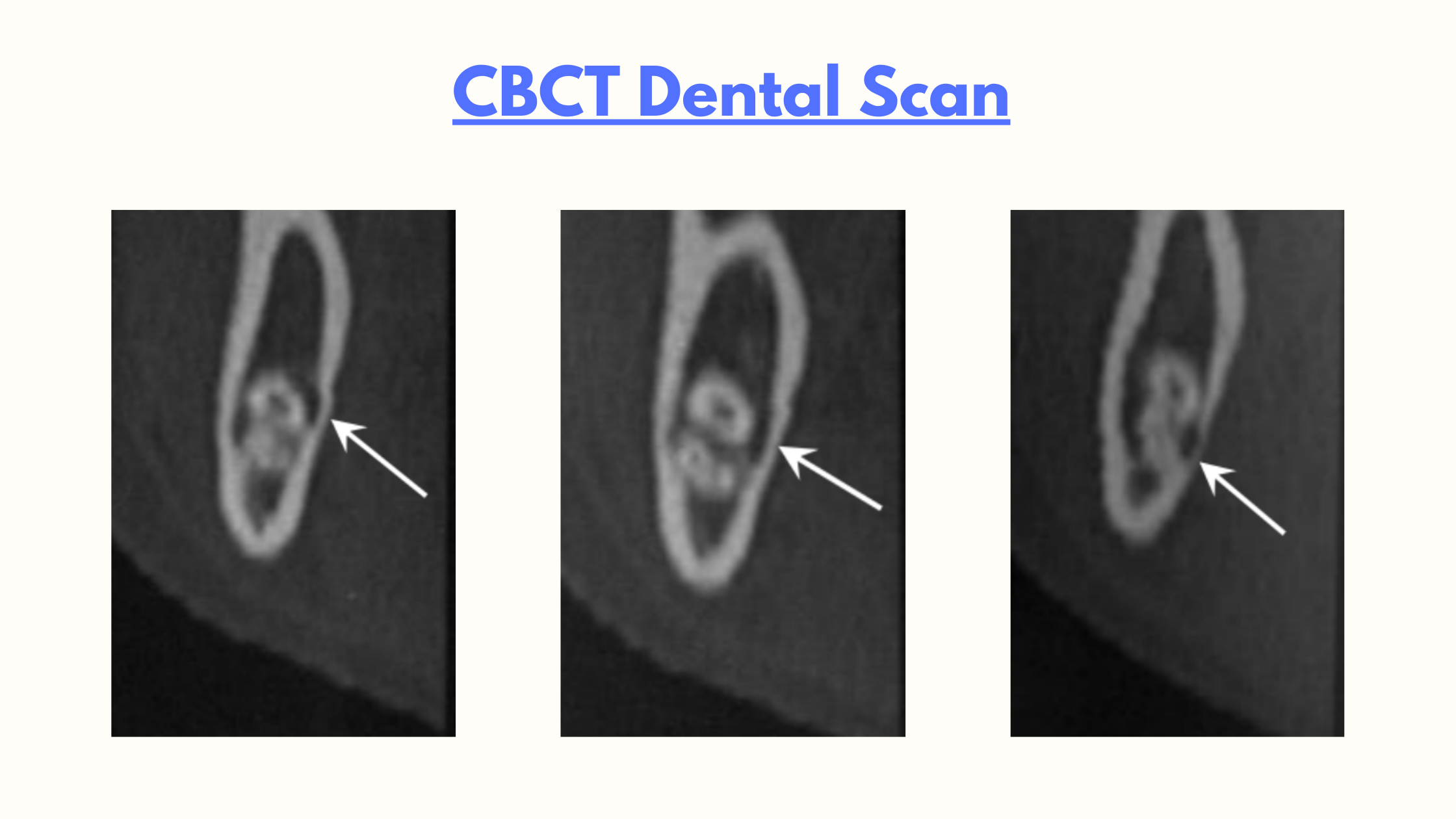 CBCT images showing the close relationship between the wisdom teeth and the inferior alveolar canal.