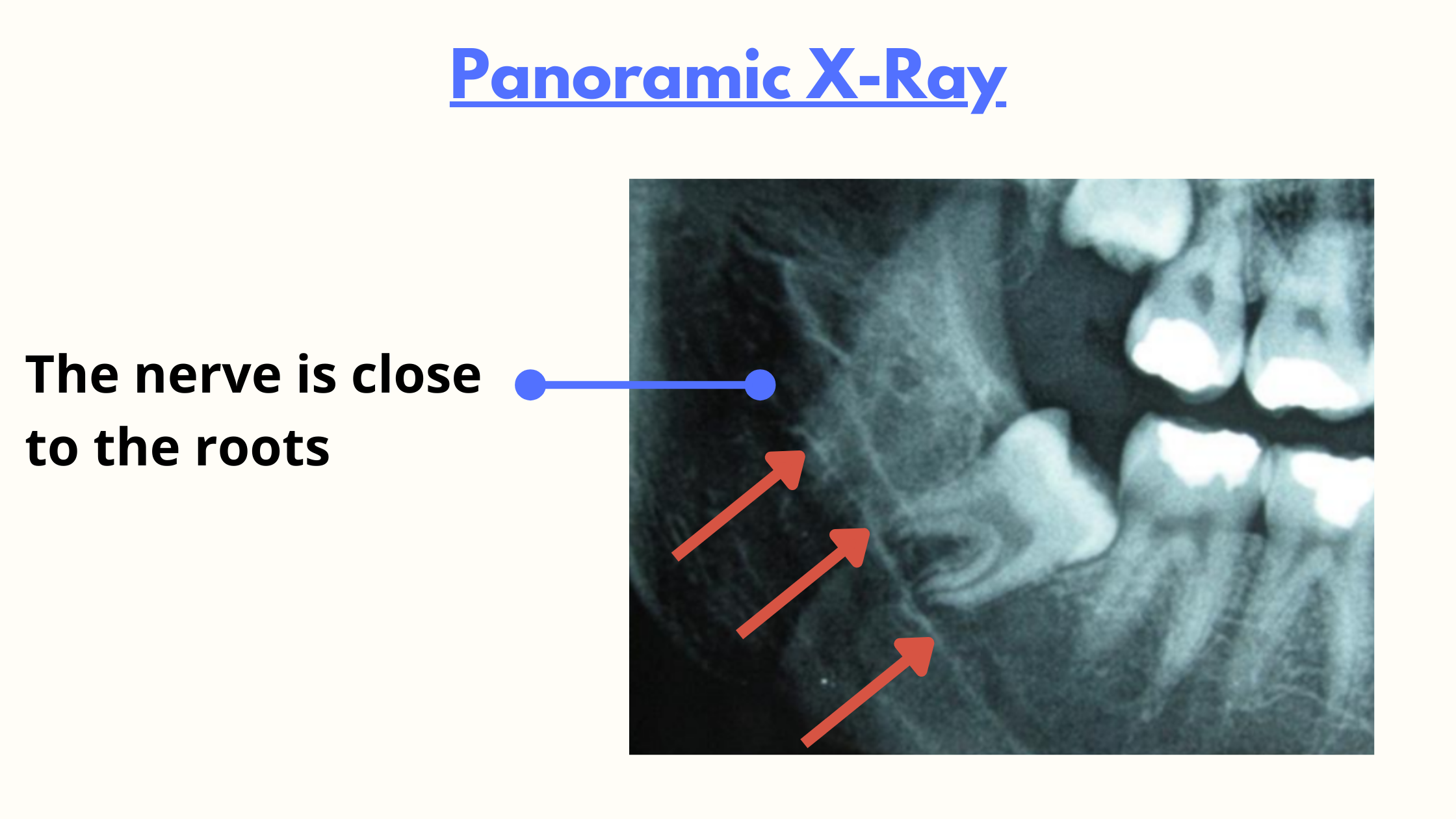 Panoramic x-ray showing the inferior alveolar canal close to the roots