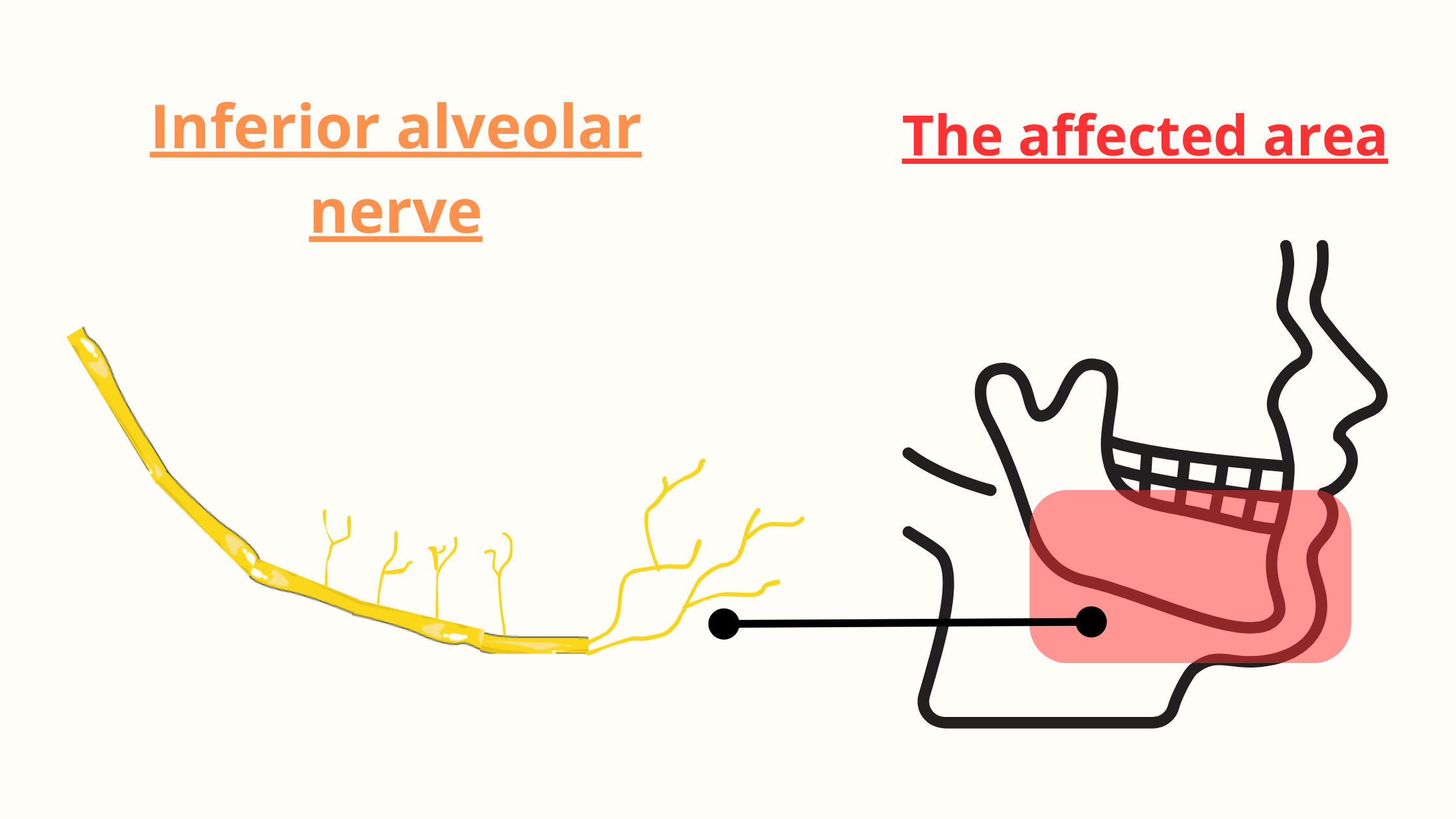 Inferior alveolar nerve damage effects