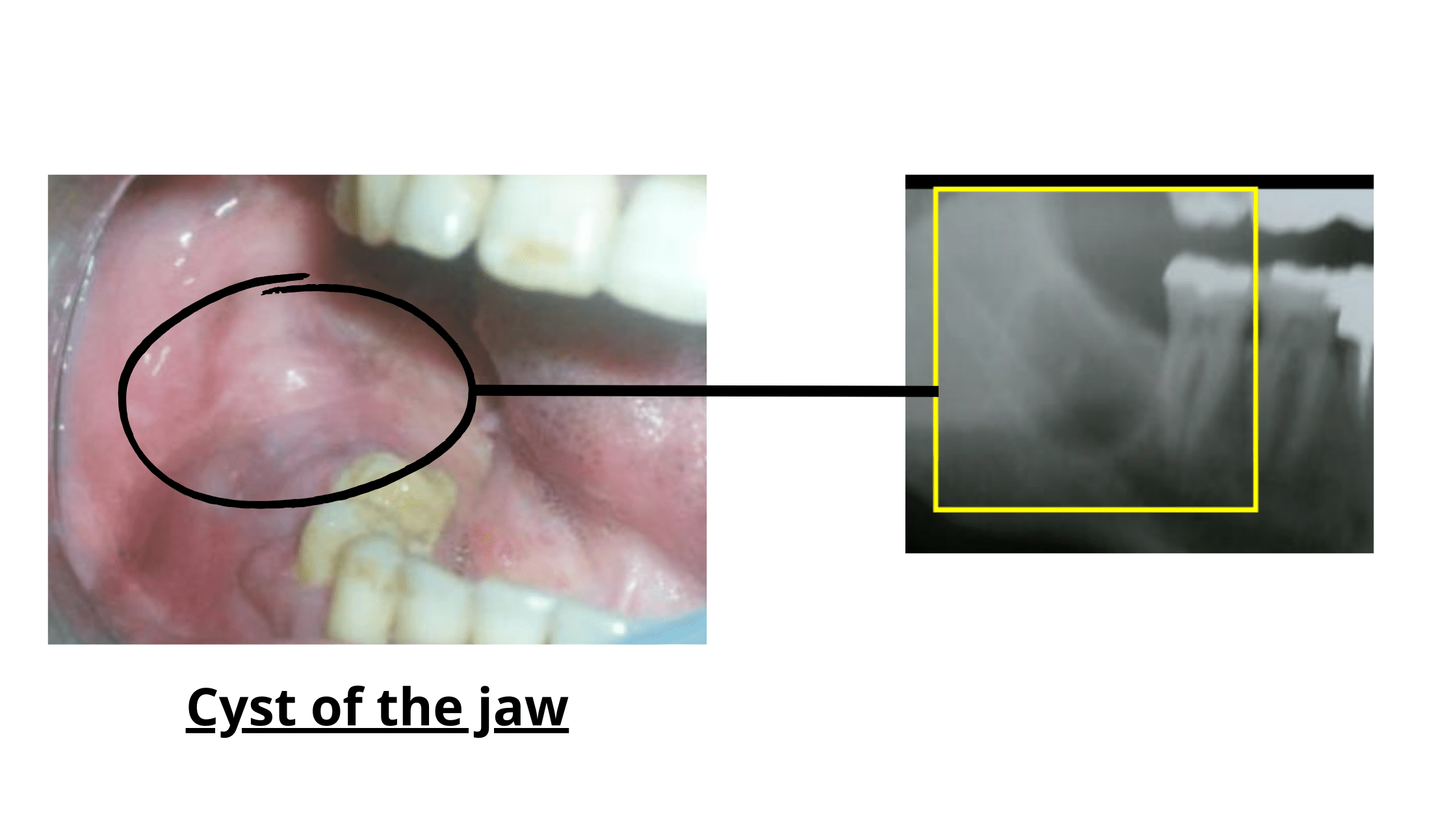 cyst on the jaw after tooth extraction