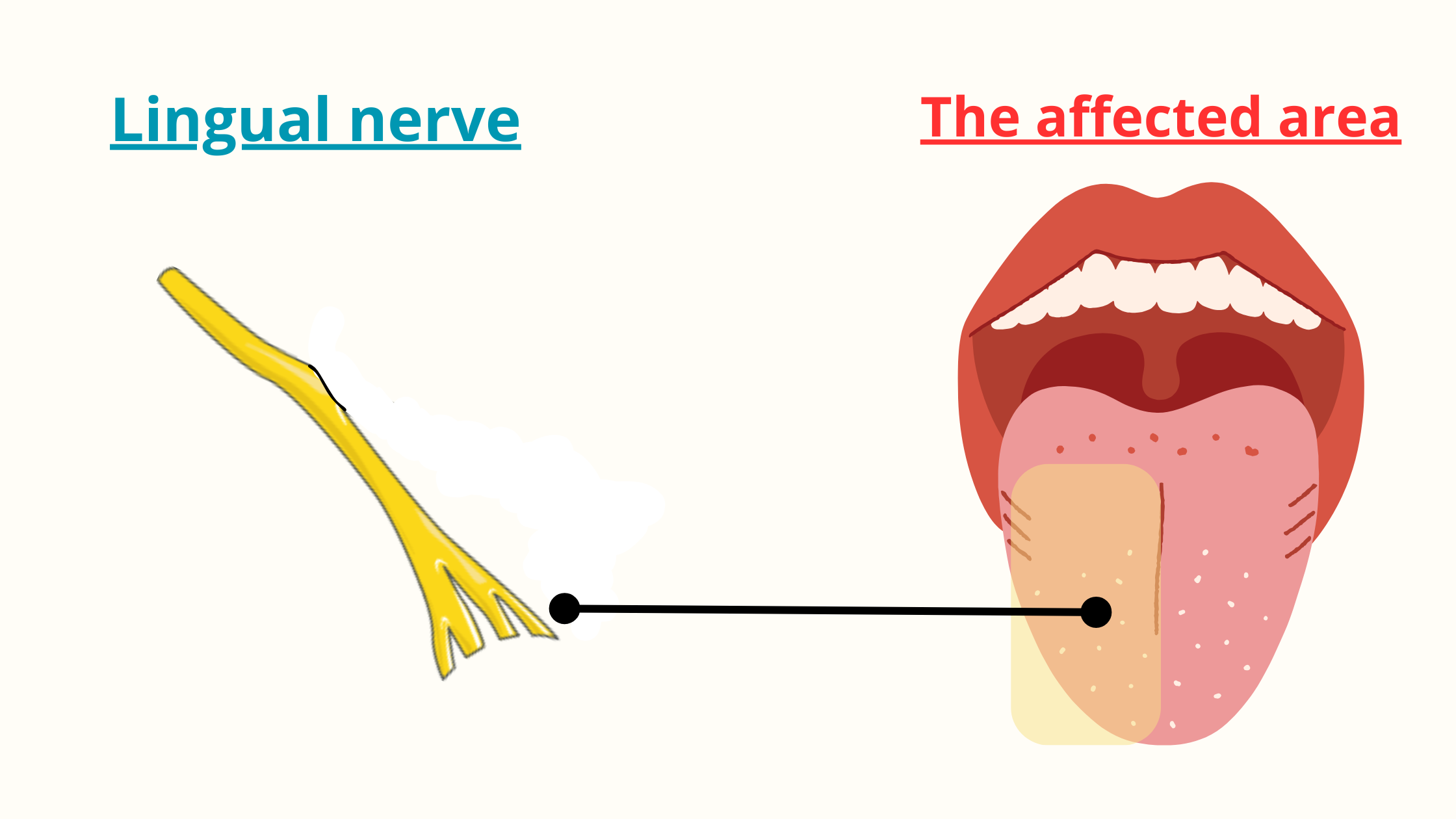 Lingual nerve damage effects