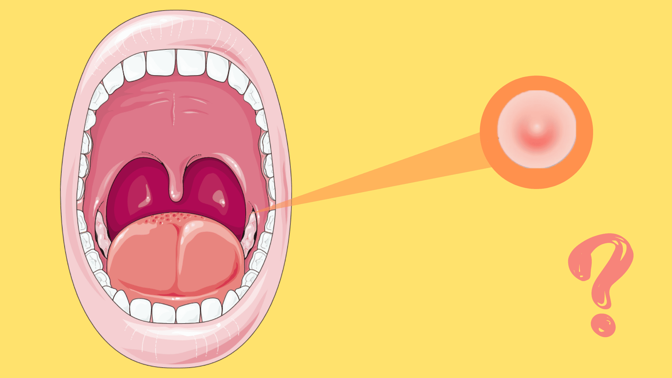 bump inside of mouth on cheek