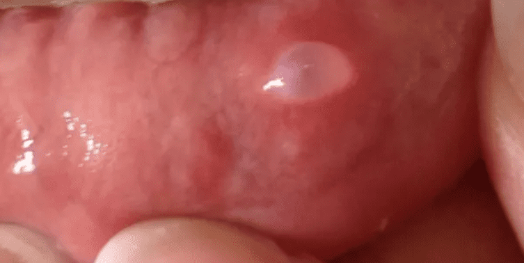 Mucocele on the lower lip