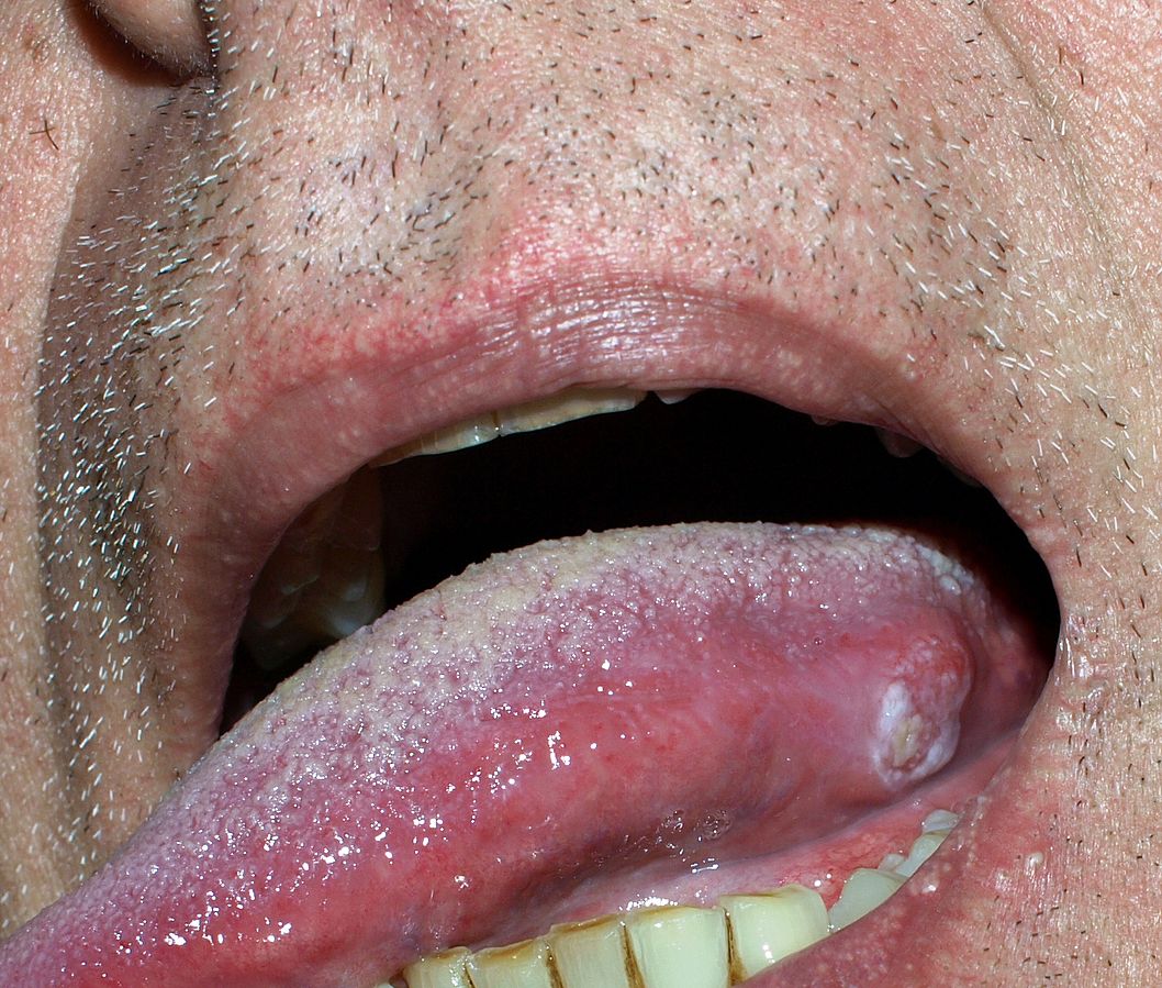 Oral Cancer Tongue 
