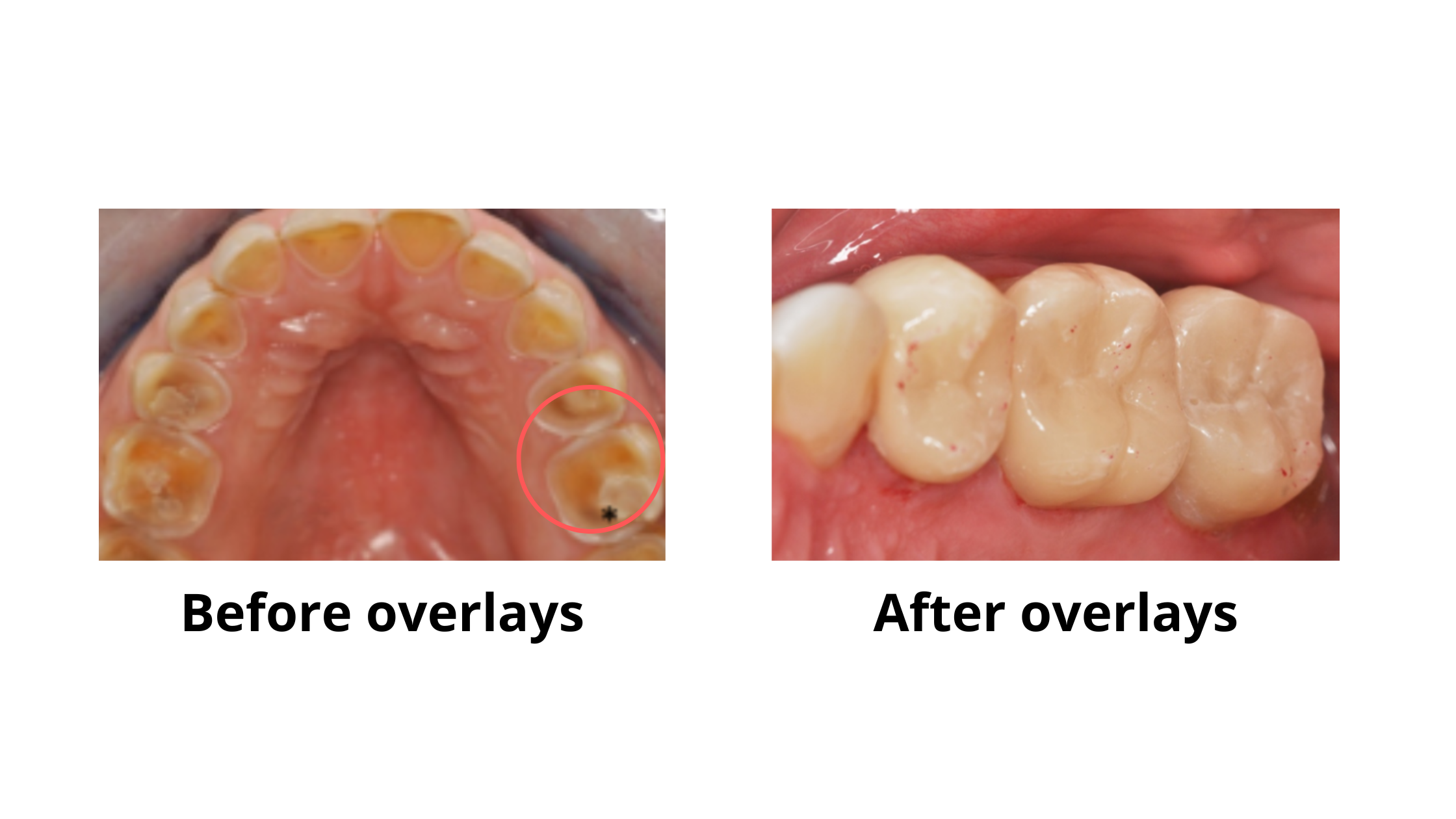 How to Fix Worn Down Teeth - Treatment and Repair - Vancouver