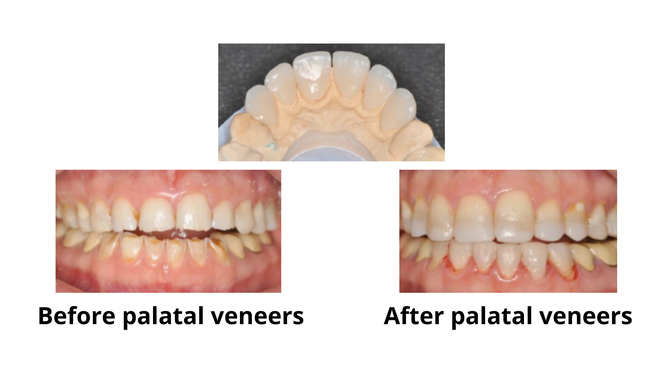 palatal veneer for worn down front teeth before and after: Restoring the back side of damaged teeth 