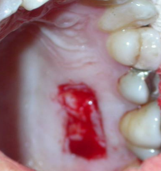 The palate (donor site) after free gingival graft