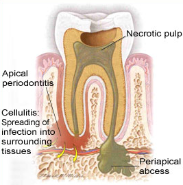 periapical abscess