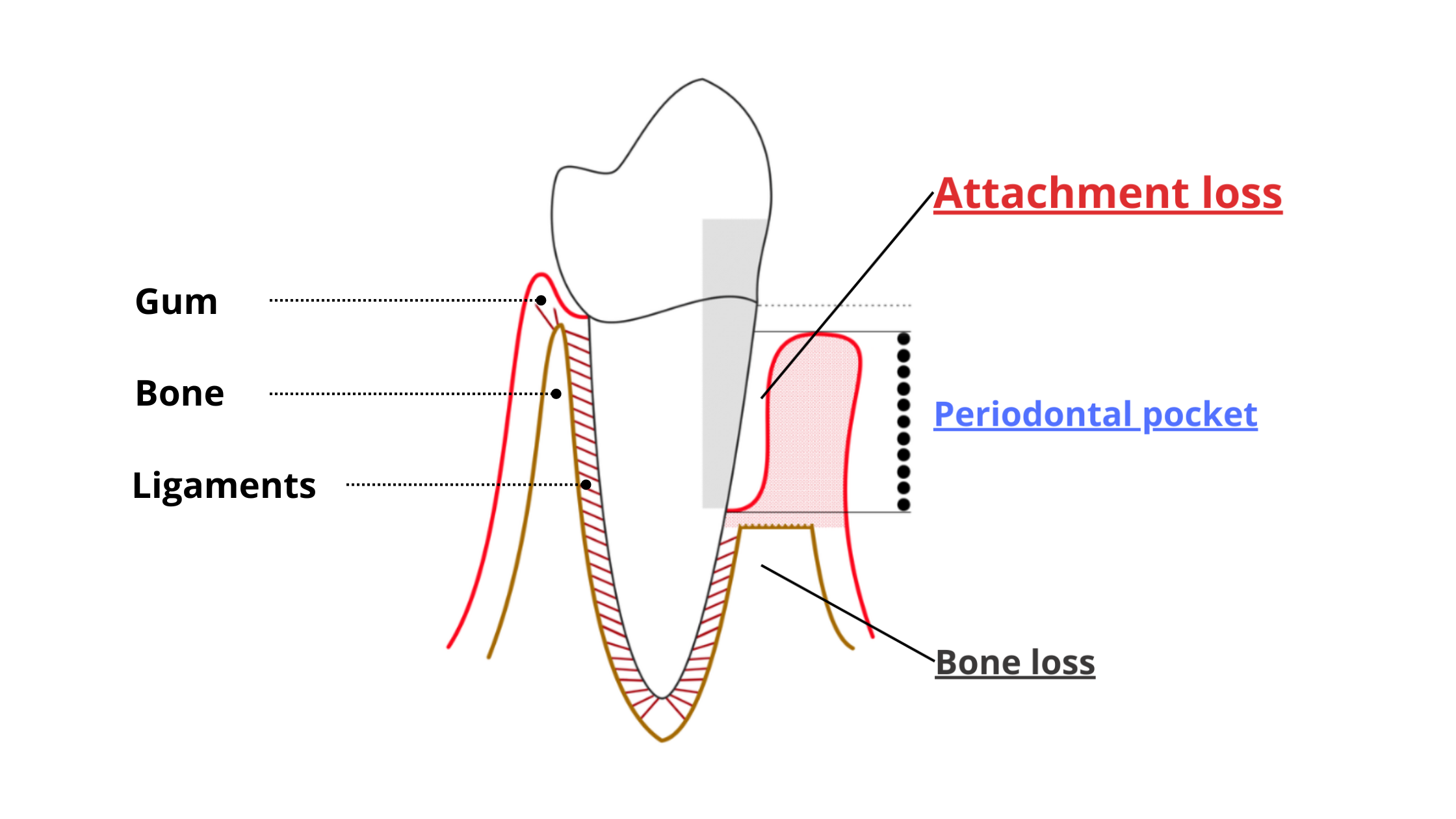 Periodontal attachment loss due to periodontitis