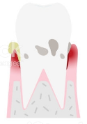 Third stage of periodotal disease: Moderate periodontal disease