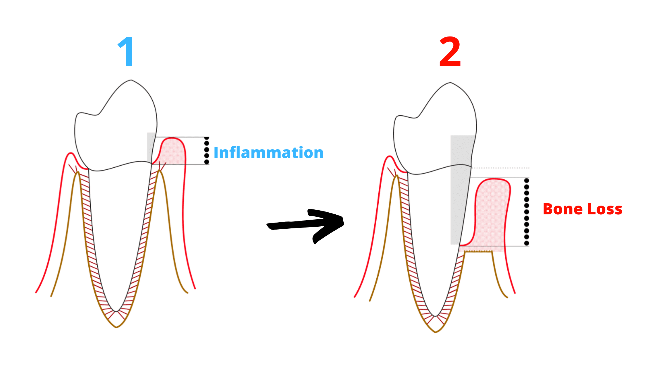  periodontal disease stages
